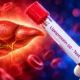Pelacarsen Lp(a)HORIZON missed cardiovascular event endpoint